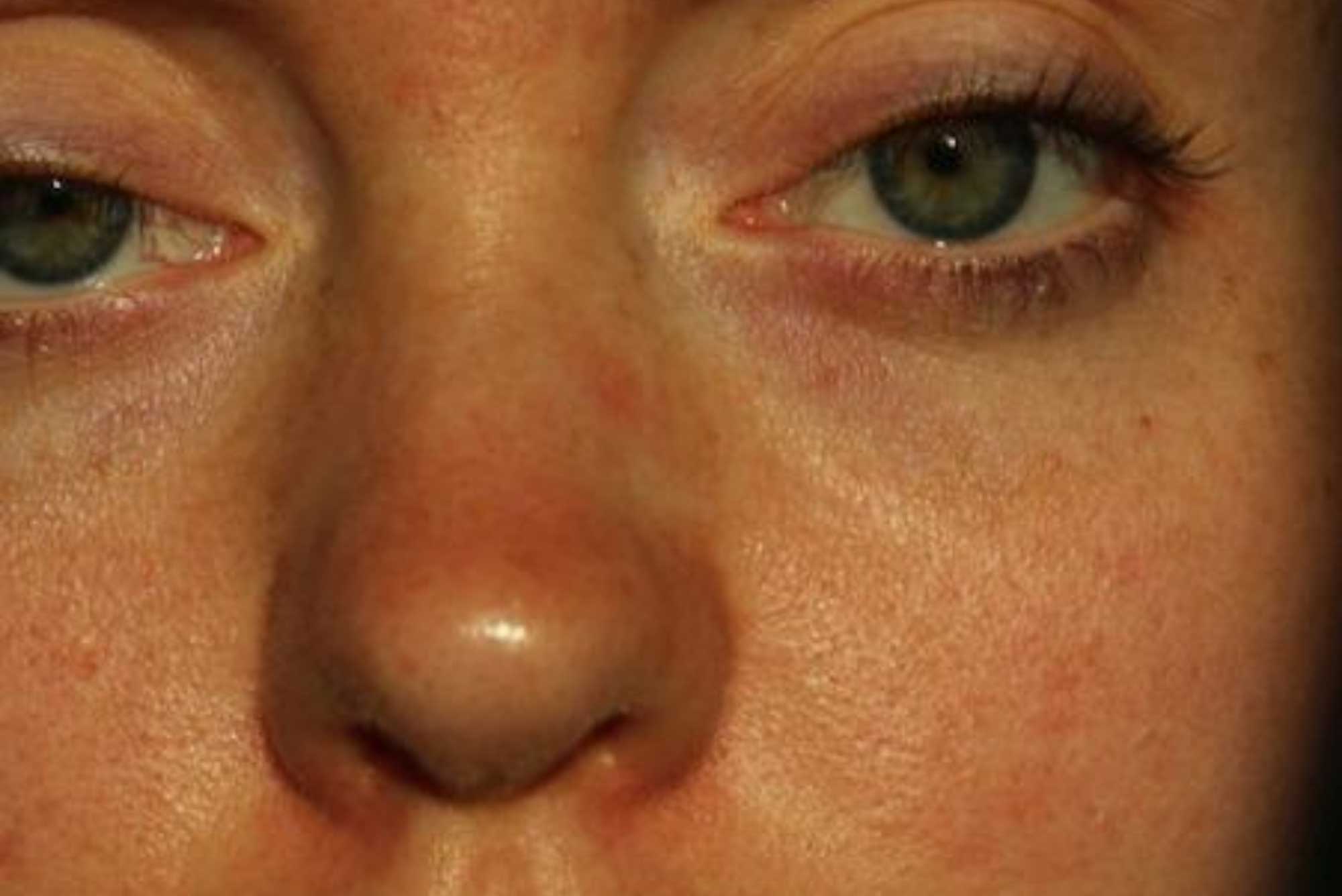Image of Rosacea