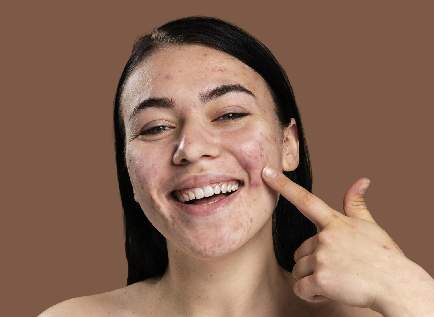 Cooling, Clearing, and Calming: An Ayurvedic Approach to Acne Care